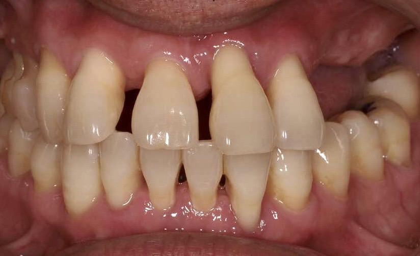 佐賀市の歯医者、池田歯科こども歯科で歯周病治療