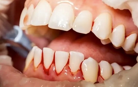 佐賀市の歯医者、池田歯科こども歯科で歯周病治療