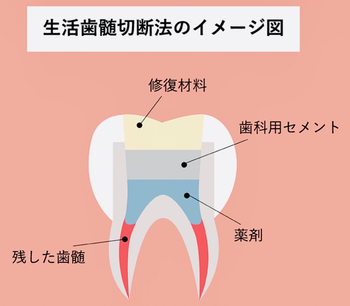 佐賀市の歯医者、池田歯科こども歯科の「歯の神経を守る」専門サイト
