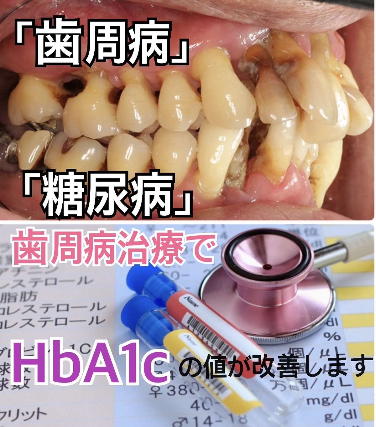 佐賀市の歯医者、池田歯科こども歯科の糖尿病歯周病専門サイト