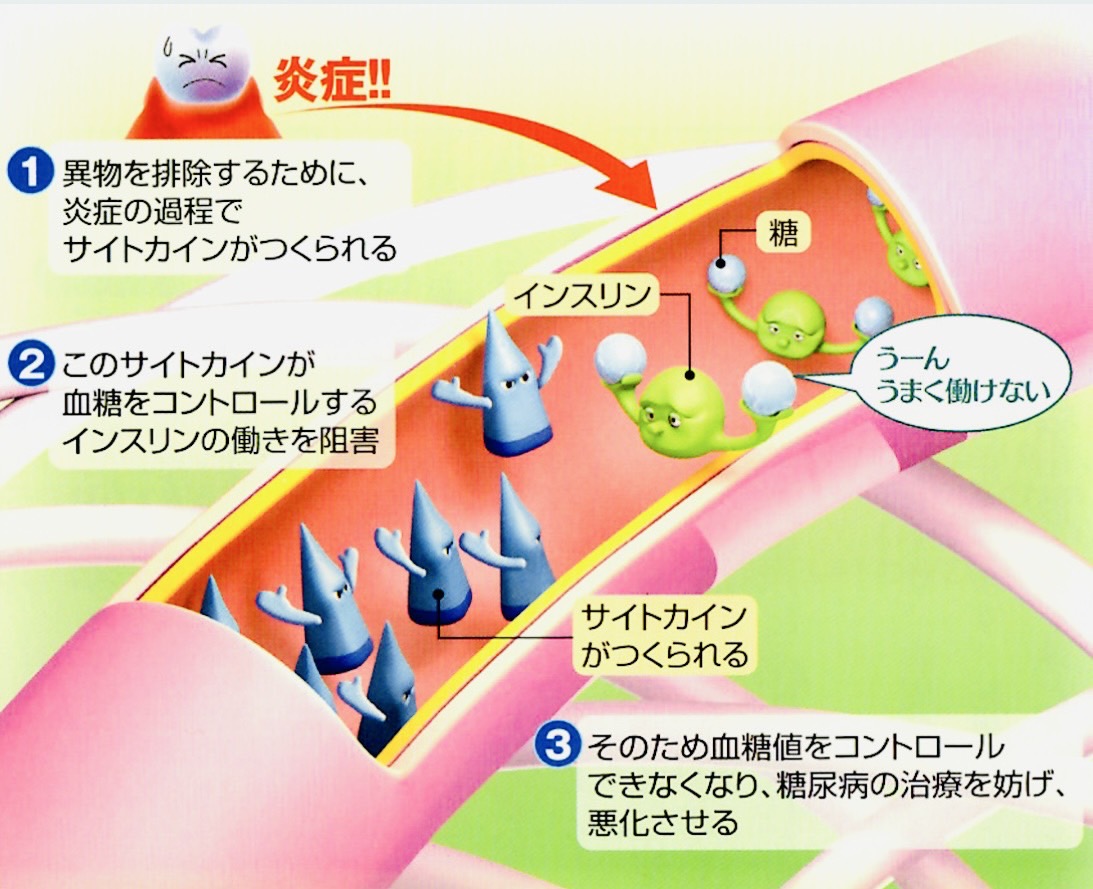佐賀市の歯医者、池田歯科こども歯科の糖尿病歯周病専門サイト
