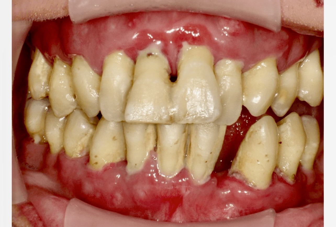 佐賀市の歯医者、池田歯科こども歯科の糖尿病歯周病専門サイト