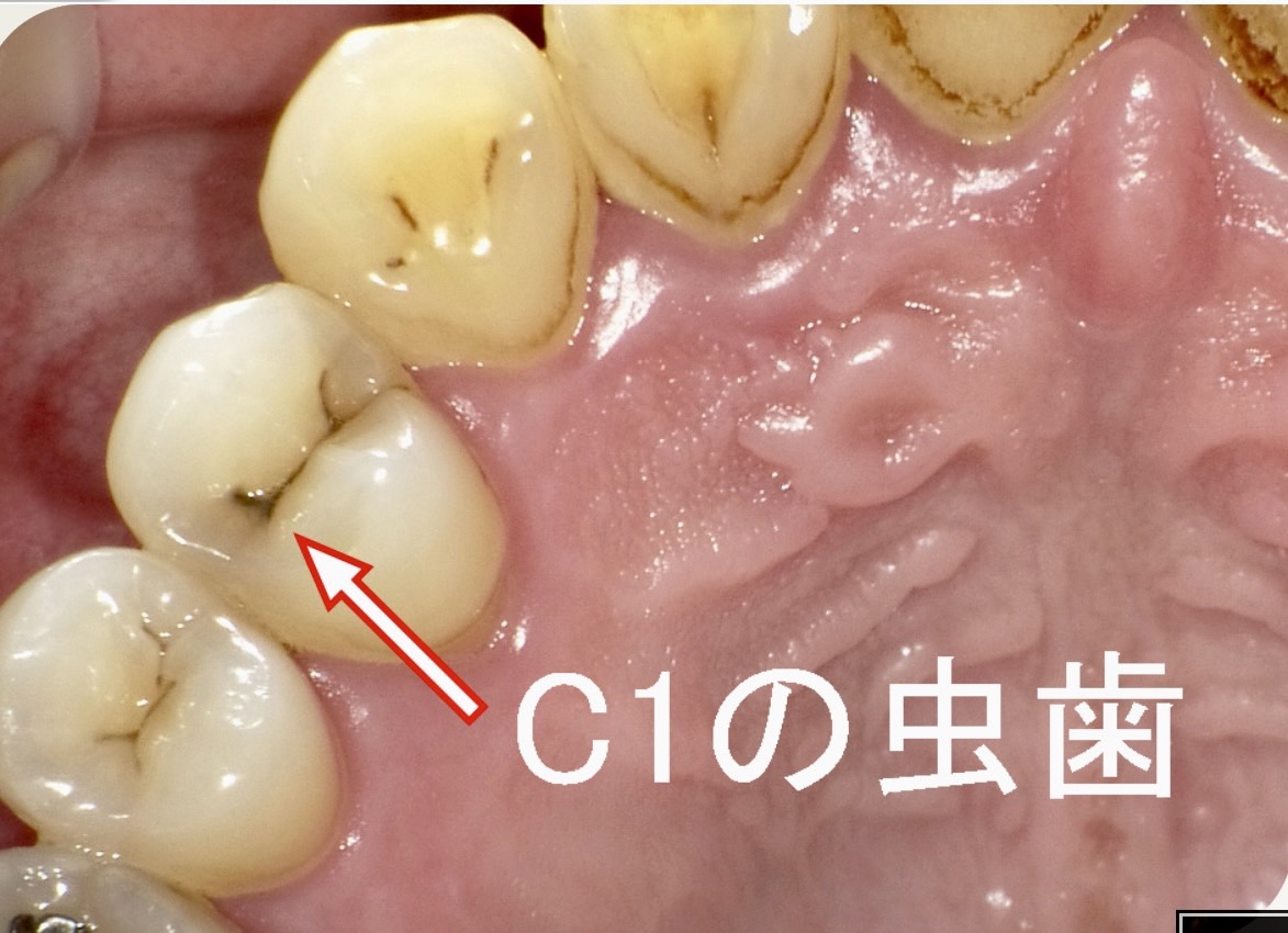 佐賀市の歯医者、池田歯科こども歯科のむし歯治療専門サイト