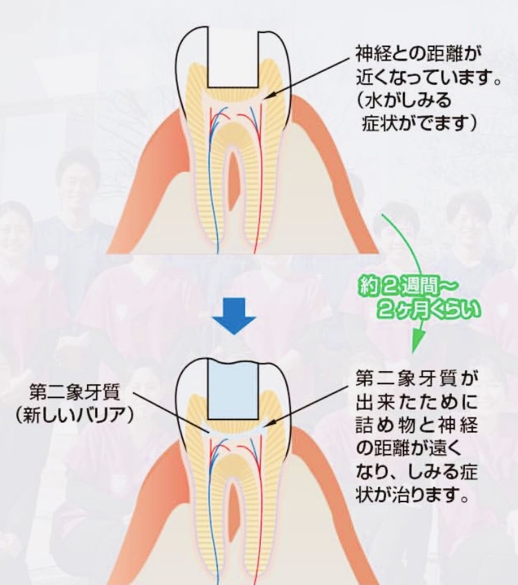 佐賀市の歯医者、池田歯科こども歯科のむし歯治療専門サイト