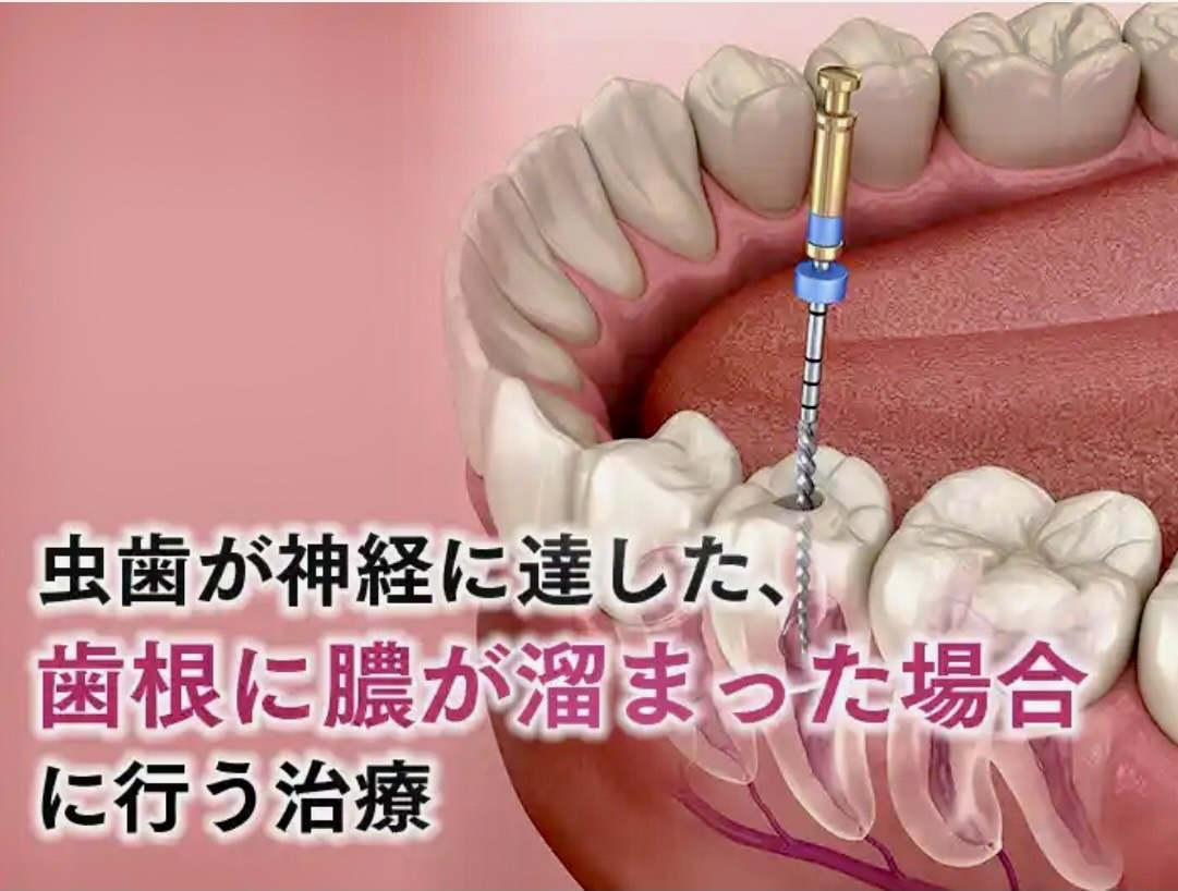 佐賀市の歯医者、池田歯科こども歯科のむし歯治療専門サイト