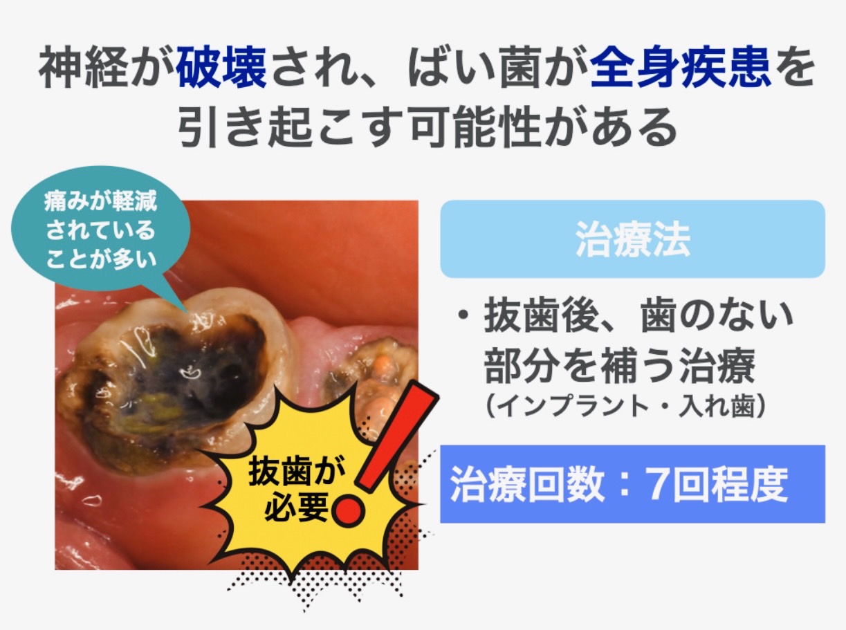 佐賀市の歯医者、池田歯科こども歯科のむし歯治療専門サイト