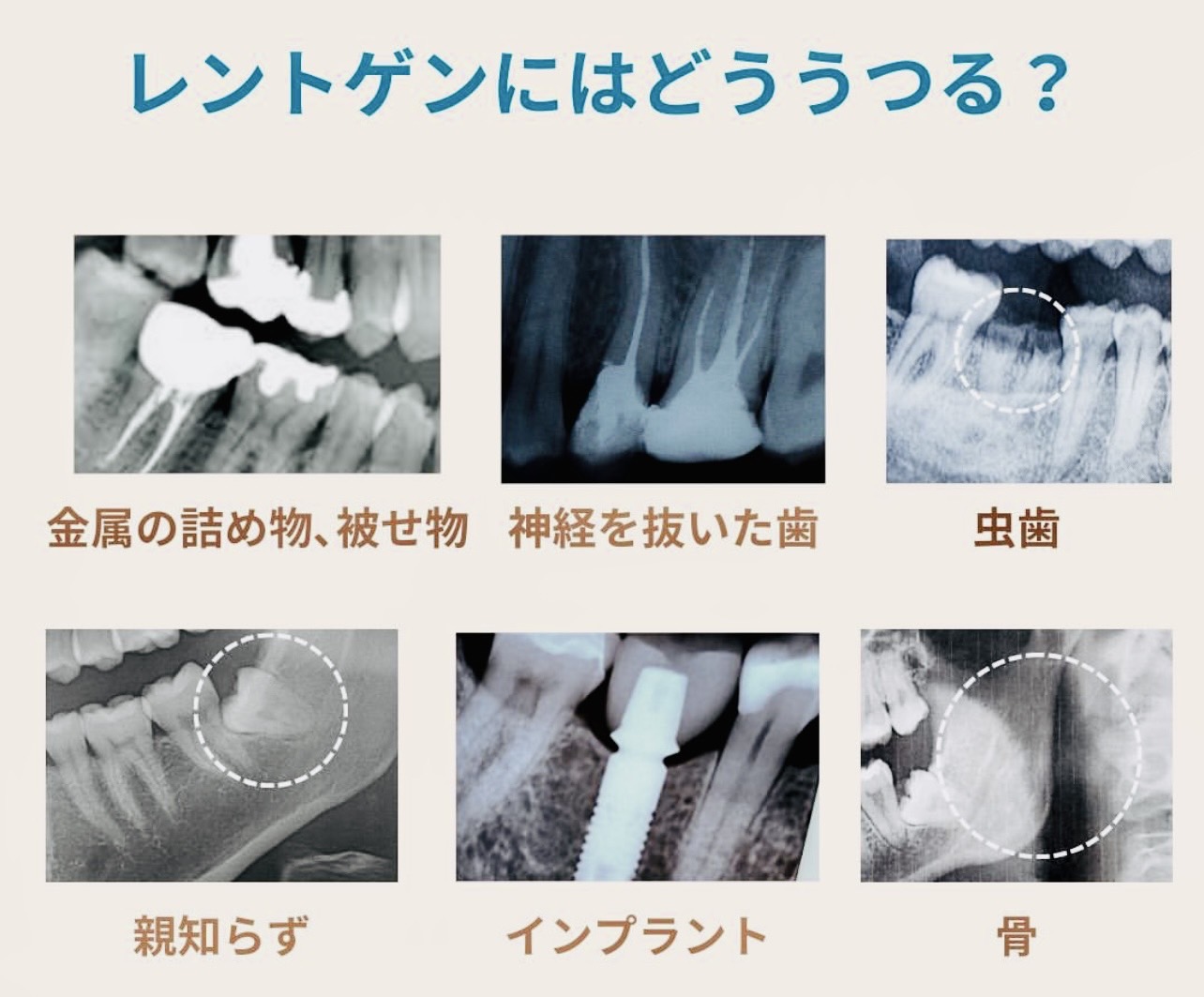 佐賀市の歯医者、池田歯科こども歯科のむし歯治療専門サイト