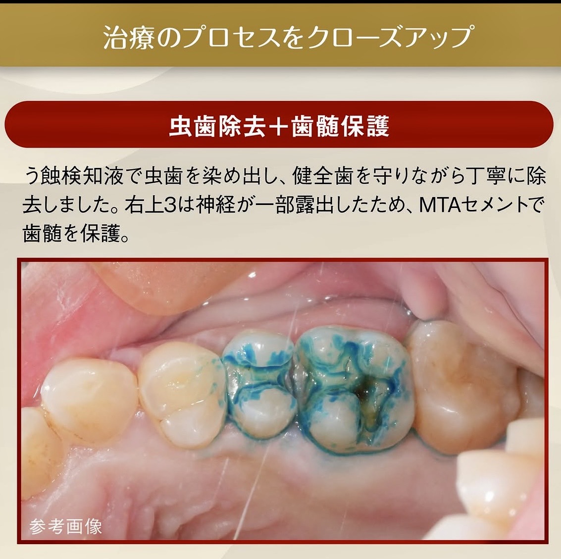 佐賀市の歯医者、池田歯科こども歯科のむし歯治療専門サイト