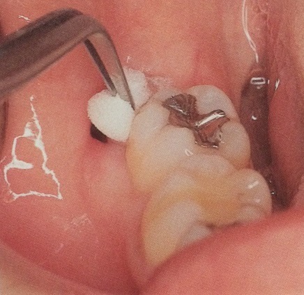 佐賀市の歯医者、池田歯科こども歯科で親知らずの抜歯