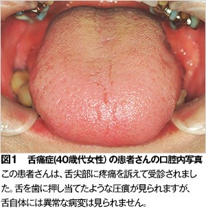 佐賀市の歯医者、池田歯科こども歯科の舌痛症治療