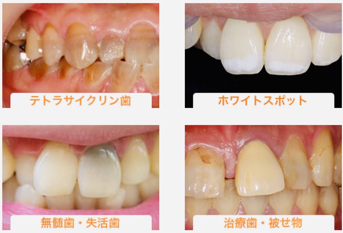 佐賀市の歯医者、池田歯科こども歯科でホワイトニング