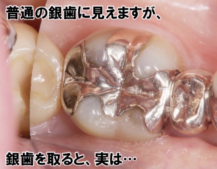 佐賀市の歯医者、池田歯科こども歯科で定期検診