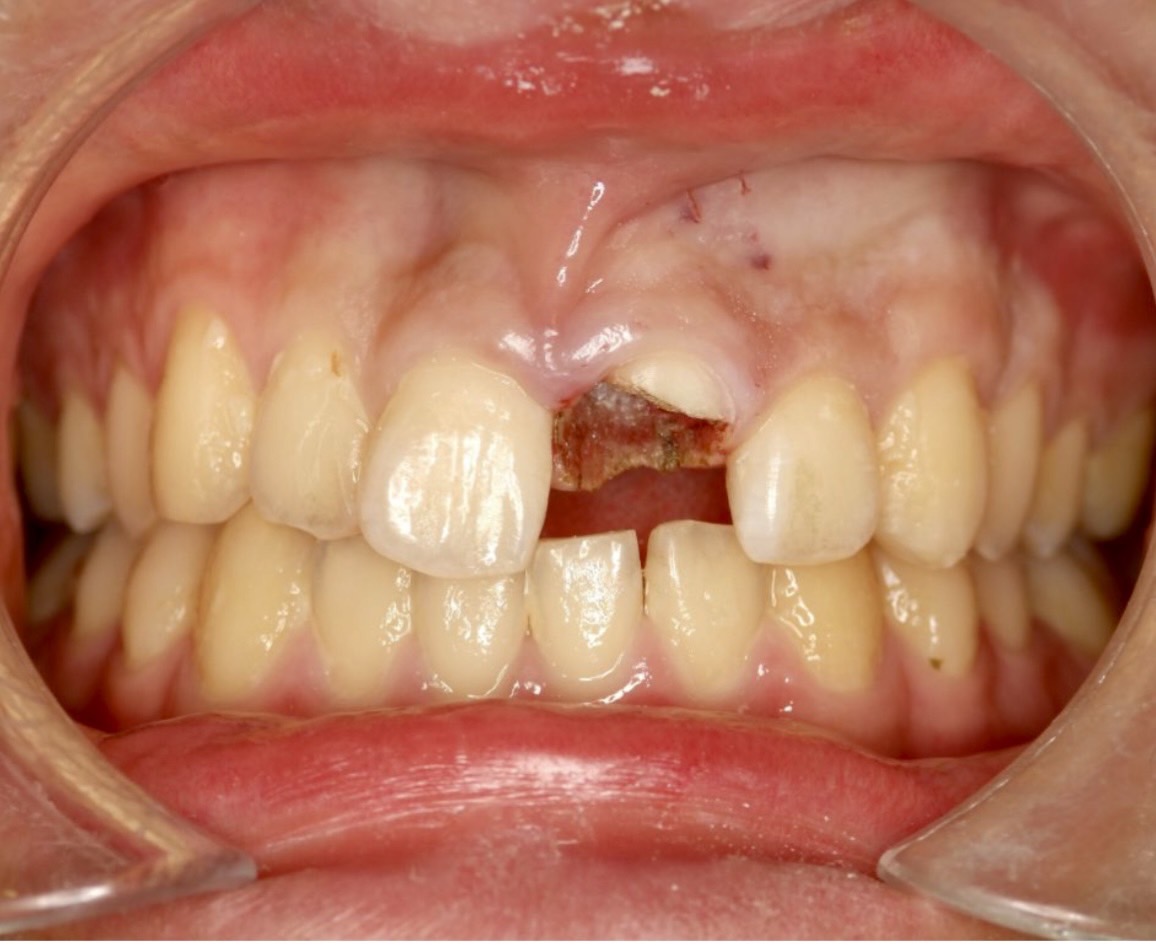 佐賀市の歯医者、池田歯科こども歯科で外傷・粘膜疾患