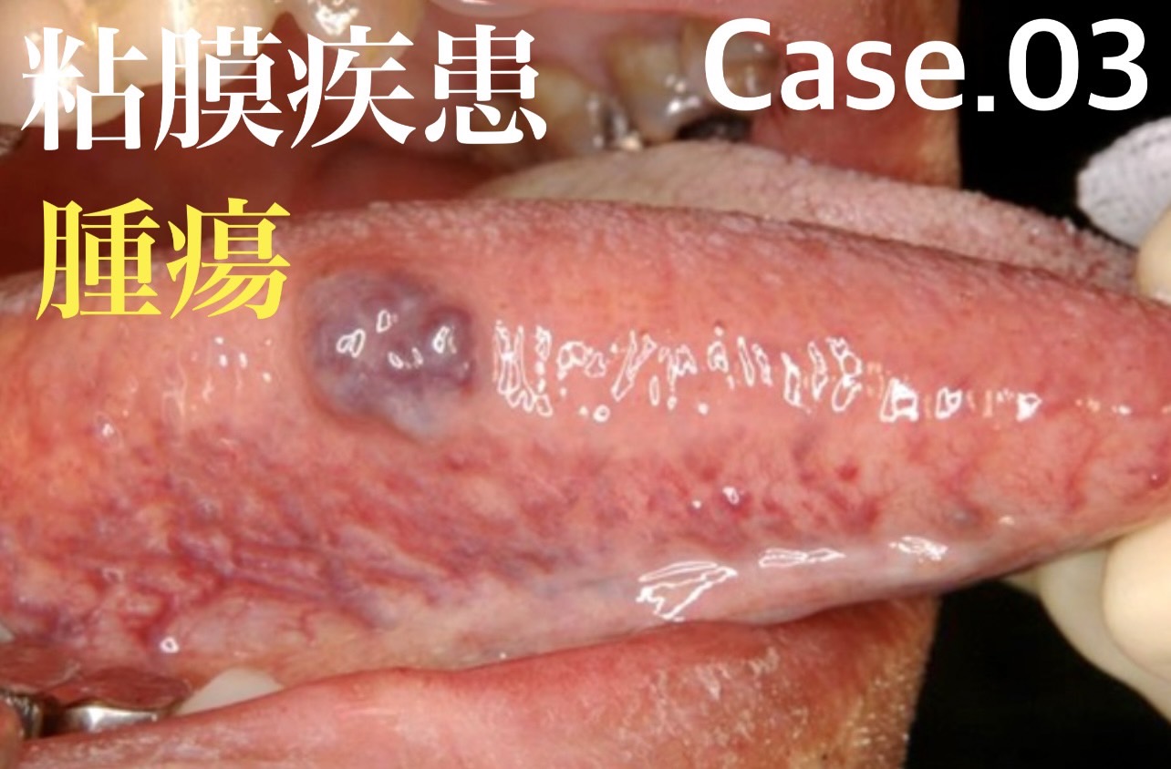 佐賀市の歯医者、池田歯科こども歯科で外傷・粘膜疾患