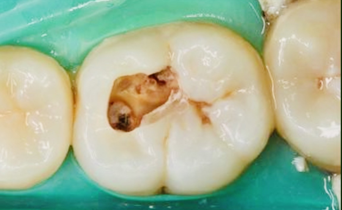 佐賀市の歯医者、池田歯科こども歯科の「歯の神経を守る」専門サイト