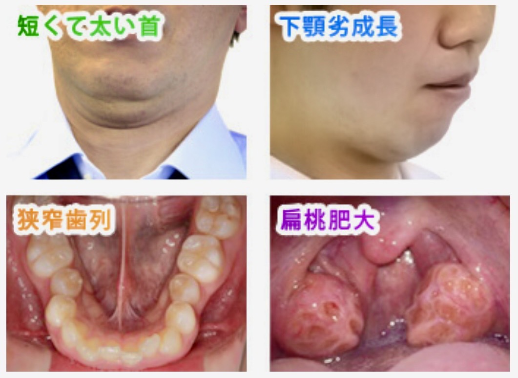 佐賀市の歯医者、池田歯科こども歯科の睡眠時無呼吸症候群・いびき専門外来