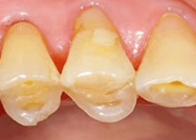佐賀市の歯医者、池田歯科こども歯科で歯ぎしりの治療
