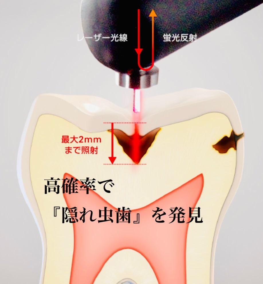 佐賀市の歯医者、池田歯科こども歯科でむし歯治療