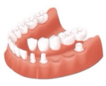 佐賀市の歯医者、池田歯科こども歯科でブリッジ治療