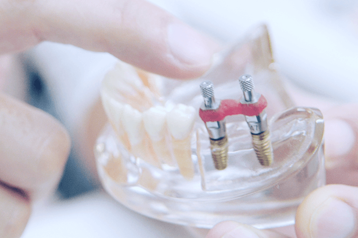 佐賀市の歯医者、池田歯科こども歯科でインプラント治療