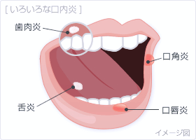 佐賀市の歯医者、池田歯科こども歯科で口内炎治療