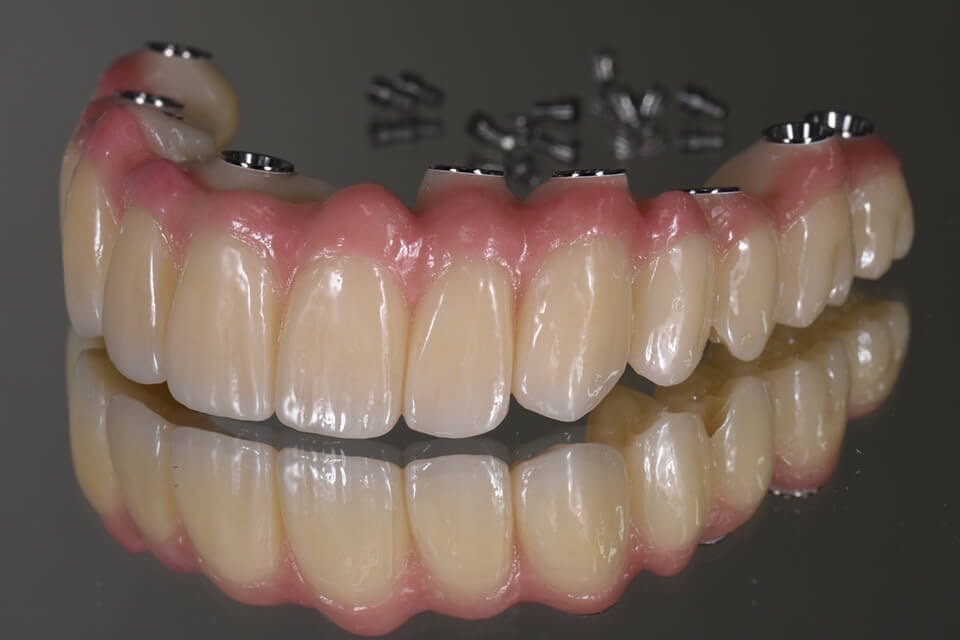 佐賀市の歯医者、池田歯科こども歯科でインプラント治療